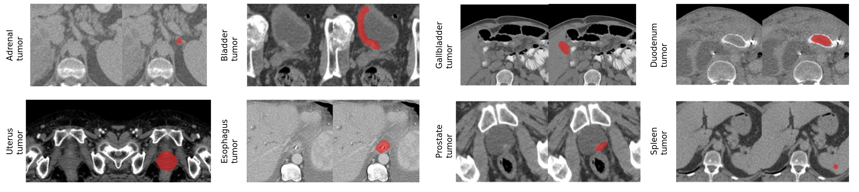 Examples of tumor annotations in Merlin Plus